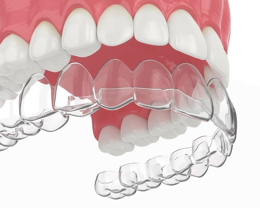Ilustração de alinhador transparente sobre os dentes